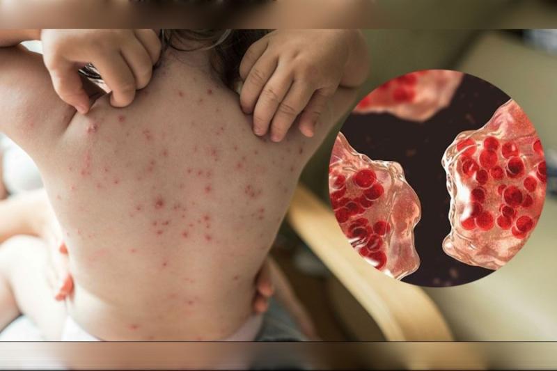 65ba47874cf05-measles-chicken-pox-311341944-16x9-copy-900x600.jpg