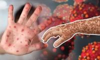mmch-measles-outbreak-children-hospitalized.jpg